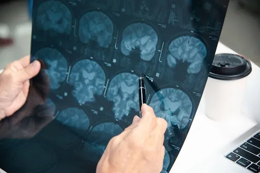 Hands holding and pointing at a brain MRI scan film with a pen, laptop nearby.
